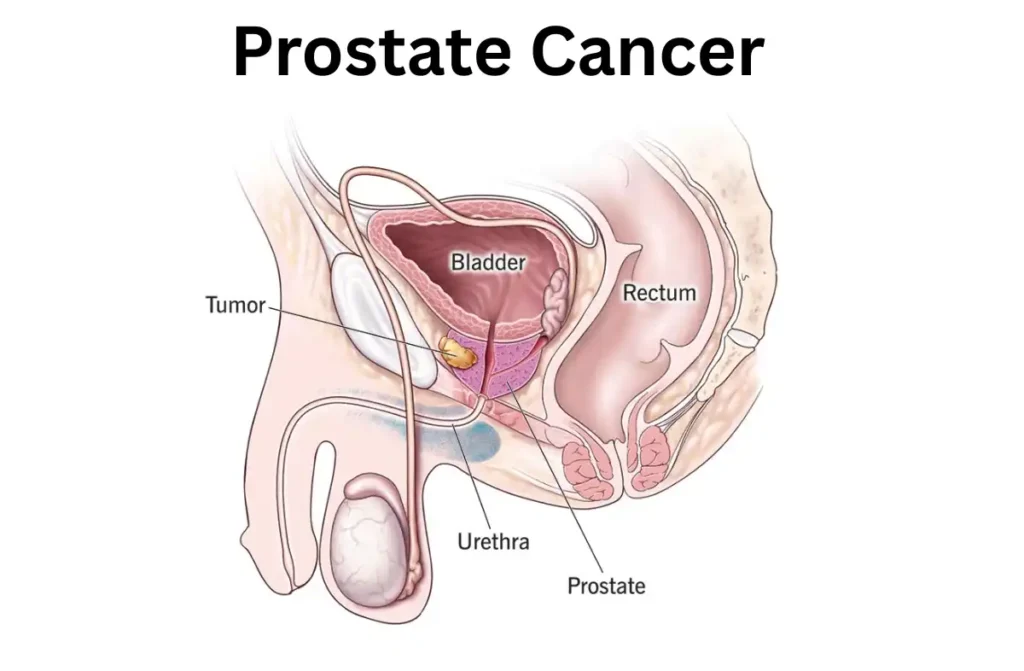 Signs You are Dying of Prostate Cancer