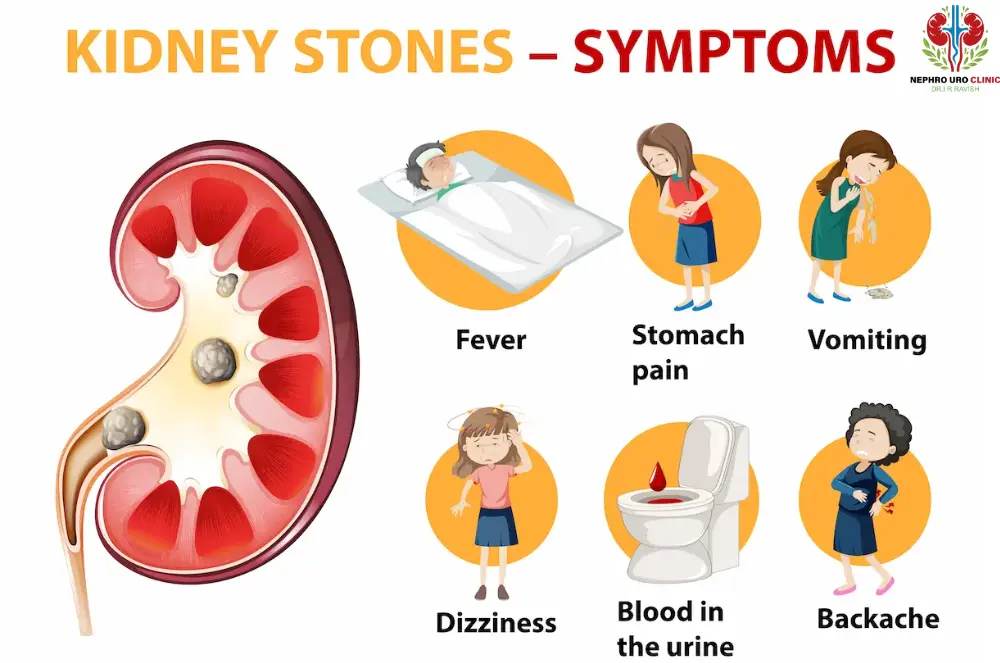 Kidney stone symptoms | Best Foods for Kidney Health
