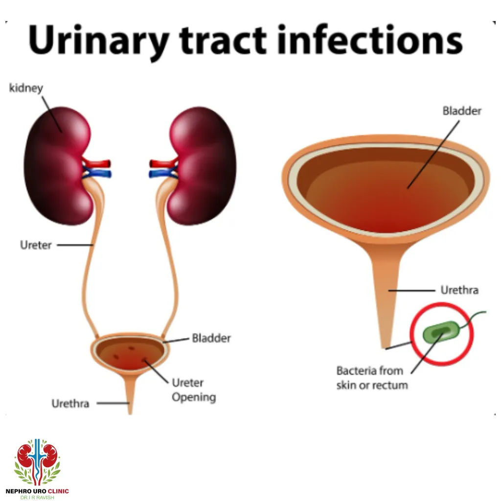 Can Smoking Cause a UTI