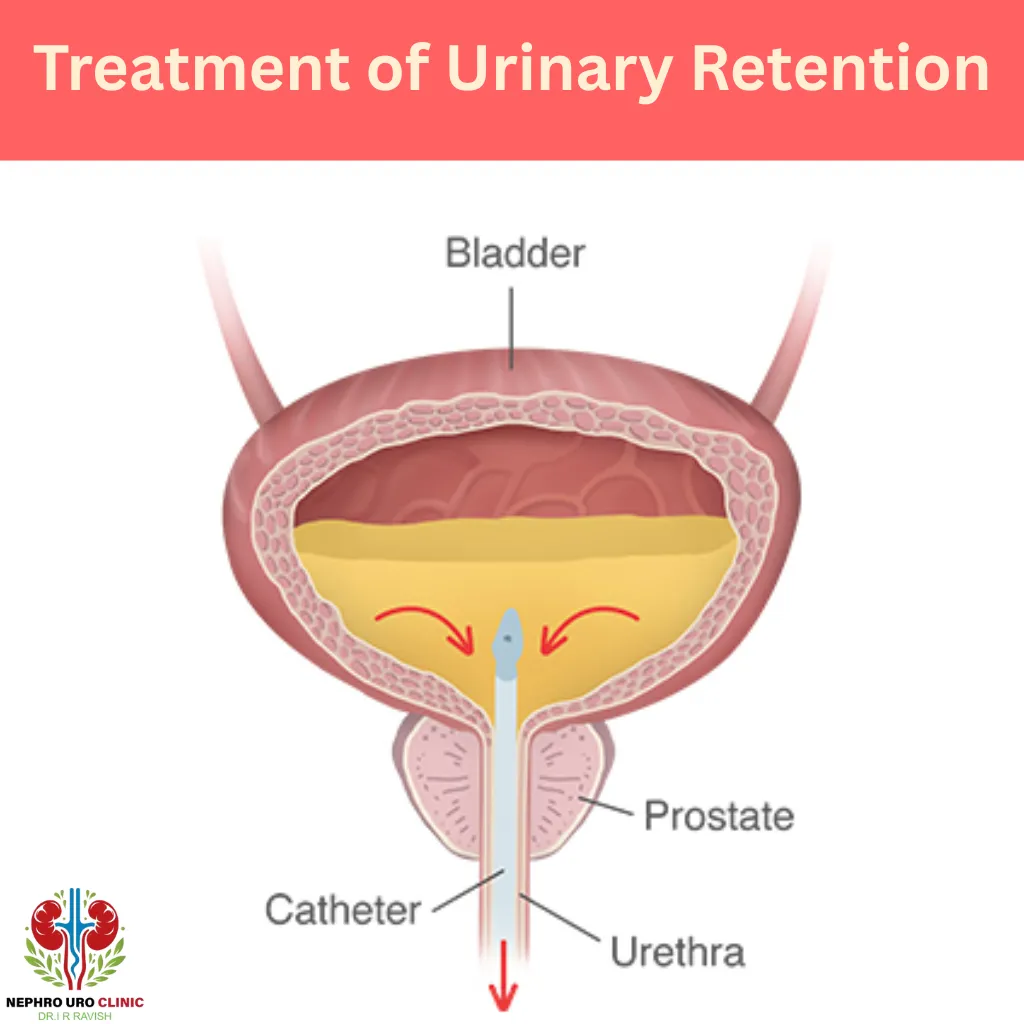 Incomplete Bladder Emptying Treatment